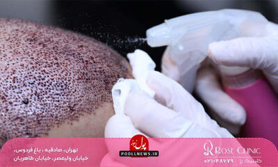 چند روز بعد از کاشت مو ریزش شروع می شود​؟