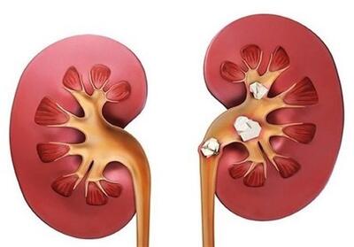 علائم سنگ کلیه؛ چه افرادی بیشتر در معرض ابتلا هستند؟ - تسنیم