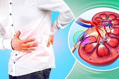 سنگ کلیه و علت تشکیل آن چیست ؟ ؛ علائم شایع سنگ کلیه