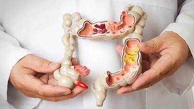 ملین خانگی چیست؟ خواص و فواید ملین و معرفی انواع ملین