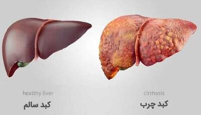 ویتامین کبد چیست؟/ ۵ ویتامین برای سلامتی کبد