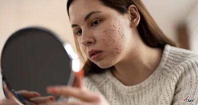 دچار مشکلات پوستی صورت پس از بارداری شده‌اید؟ متخصص پوست توصیه می‌کند چه کارهایی انجام دهید