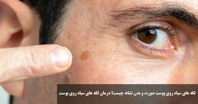 لکه های سیاه روی پوست صورت و بدن نشانه چیست؟ درمان لکه های سیاه روی پوست