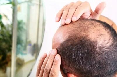 کشف تصادفی درمان طاسی؛ این قند طبیعی می‌تواند باعث رشد مجدد مو ‌شود