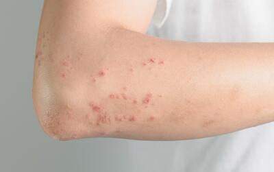 خطرات اصلاح سنتی و برتری لیزر موهای زائد در پیشگیری از موهای زیرپوستی
