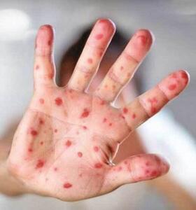 ابتلای ۴۲۲ نفر به سرخک در ۳ ماه اول سال