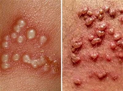 بهترین پزشکهای تهران برای درمان زگیل تناسلی؛ تفاوت و تشخیص جوش، تبخال و HPV