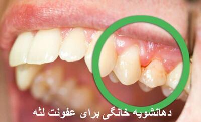 دهانشویه خانگی برای عفونت لثه + بهترین دهانشویه برای التهاب لثه