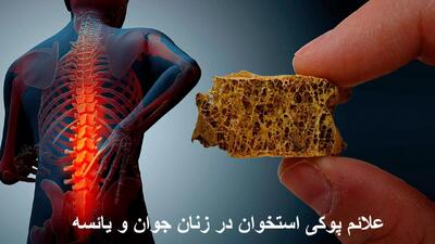 علائم پوکی استخوان در زنان جوان و یائسه | برای درمان پوکی استخوان چی بخوریم؟