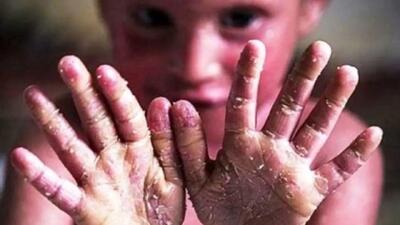 شکایت بیماران پروانه‌ای از بنیاد امور بیماری‌های خاص؛ به رغم دریافت بودجه هیچ خدماتی در ۷ سال گذشته به بیماران نداده است/ انتقاد از عدم پاسخگویی بنیاد به تمام مکاتبات