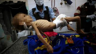 عکس/ مرگ کودک فلسطینی بر اثر سوءتغذیه در غزه
