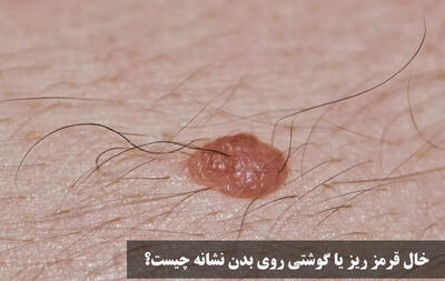 خال قرمز ریز یا گوشتی روی بدن نشانه چیست؟ علت زیاد شدن خال ریز قرمز در بدن