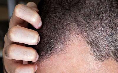 علائم اگزمای پوست سر را بشناسید/ اگزما با شوره سر چه تفاوتی دارد؟