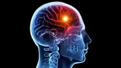 سکتهٔ مغزی ۱۴۰ هزار ایرانی در سال