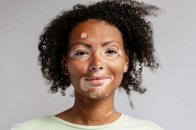  علت اصلی پیسی چیست؟ کمبود کدام ویتامین نقش دارد؟