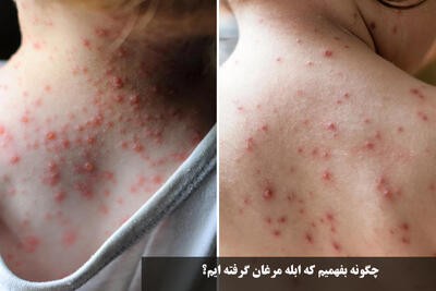 چگونه بفهمیم که آبله مرغان گرفته ایم؟ علائم آبله مرغان در کودکان و بزرگسالان