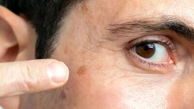چگونه نشانه‌ های اولیه سرطان پوست را بشناسیم؟