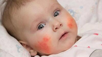 آلرژی غذایی کودکان؛ روش های تشخیص، علائم و مدیریت آلرژی نوزاد و کودک