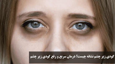 گودی زیر چشم نشانه چیست؟ درمان سریع و رفع گودی زیر چشم در خانه