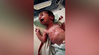 نوزاد اهل غزه به‌دلیل گرما دچار تاول و بیماری پوستی دردناک شد + فیلم