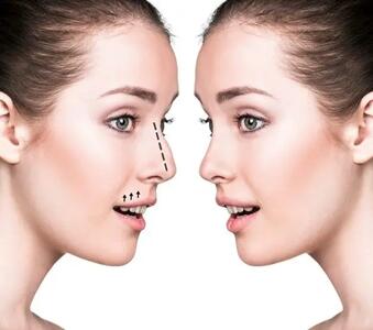 جراحی بینی در ایلام؛ راز چهره‌ای جذاب و زیبا