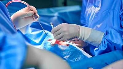 بازگشت جراحی قلب باز به قم پس از یک سال وقفه