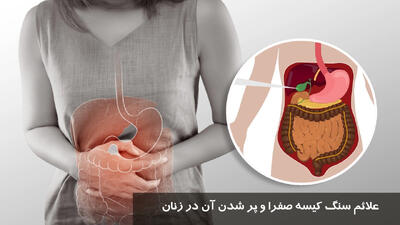 علائم سنگ کیسه صفرا و پر شدن آن در زنان + درمان خانگی کیسه صفرا در زنان