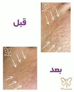 فوتونا فرکشنال یا فوردی؟ جوانسازی بدون جراحی و رفع جای جوش با لیزر فوتونا در مشهد