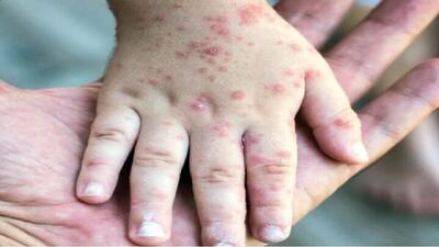 هشدار سازمان ملل نسبت به مرگ‌ومیر کودکان افغانستانی براثر ابتلا به سرخک