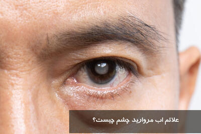 علائم اب مروارید چشم چیست؟ خطرناک است؟ درمان اب مروارید در خانه بدون جراحی