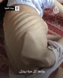 ببینید؛ قحطی در غزه، مریم ۹ ساله دیگر تنها پوست و استخوان است