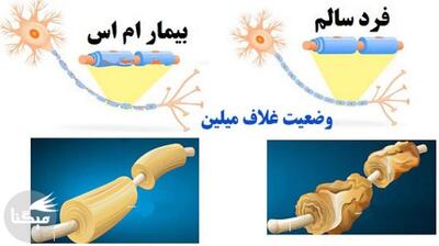 میگنا - علائم ام‌اس ۱۵سال جلوتر بروز می‌کند