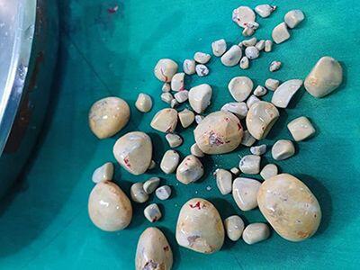 ۶۷ سنگ از مثانه بیمار ۷۰ ساله بوشهری خارج شد