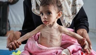 سازمان ملل: سوء تغذیه حاد در میان کودکان غزه به بالاترین سطح خود رسیده است