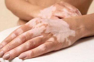 تازه‌ترین توصیه‌های پزشکی برای لک‌های پوستی - اکونیوز