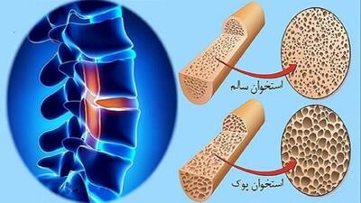 پوکی استخوان از دهه چهارم زندگی شروع می‌شود