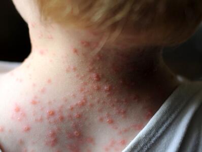 علائم ابتدا به آبله مرغان در بزرگسالی/ عوارض خطرناک ابتلا به این ویروس چیست؟