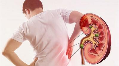 علت تشکیل مجدد سنگ کلیه پس از سنگ‌شکنی