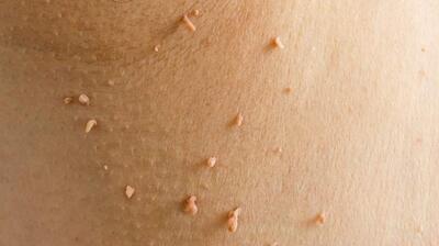 میگنا - اسکین تگ (Skin Tag)  چیست ؟
