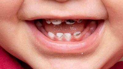 میگنا - چرا بعضی‌ها مسواک نمی‌زنند ؟