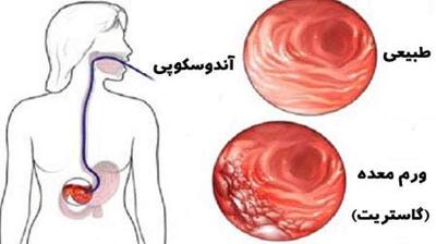 میگنا - رژیم غذایی برای ورم معده