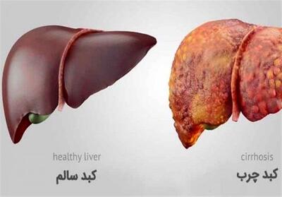 اگر کبد چرب دارید حتما این مطلب را بخوانید