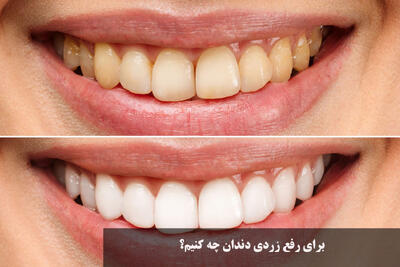 برای رفع زردی دندان چه کنیم؟ رفع قطعی زردی دندان به روش خانگی در یک روز