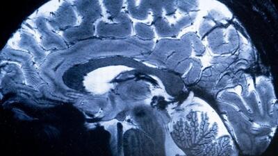 کمبود این ماده مغذی می‌تواند باعث ابتلا به آلزایمر شود