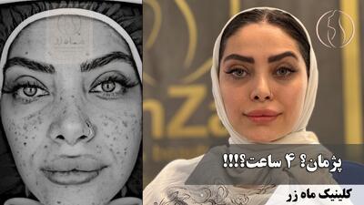 می‌شه جای جوش کمتر شه؟ ( کلینیک زیبایی ماه زر )