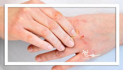 روش‌های غیردارویی برای کنترل التهاب