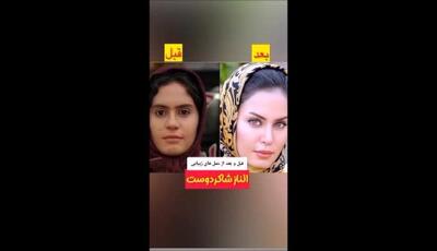 از بینی‌های طبیعی تا چهره‌های ژل‌دار؛ سلبریتی‌ها قبل و بعد از عمل‌های زیبایی
