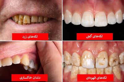 رنگ دندان از دیدگاه علم چه چیزهایی درباره سلامت شما می‌گوید؟