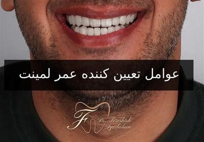 عمر لمینت دندان : لمینت دندان چقدر عمر می‌کند؟ - تسنیم
