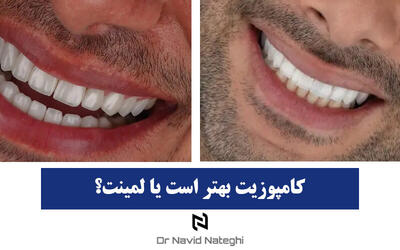 کامپوزیت بهتر است یا لمینت؟ مقایسه قیمت، مزایا و معایب ۱۴۰۴
